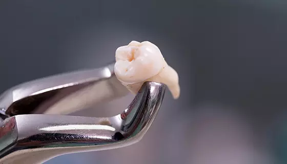 Больно ли удалять зуб?