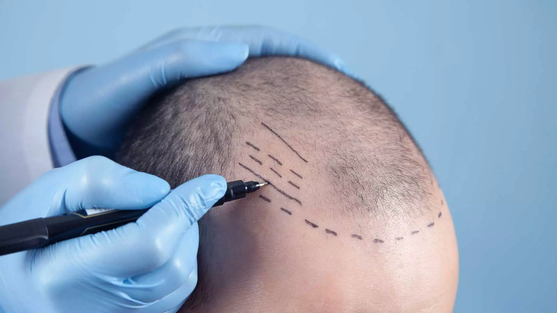 How long do hair transplant lasts?