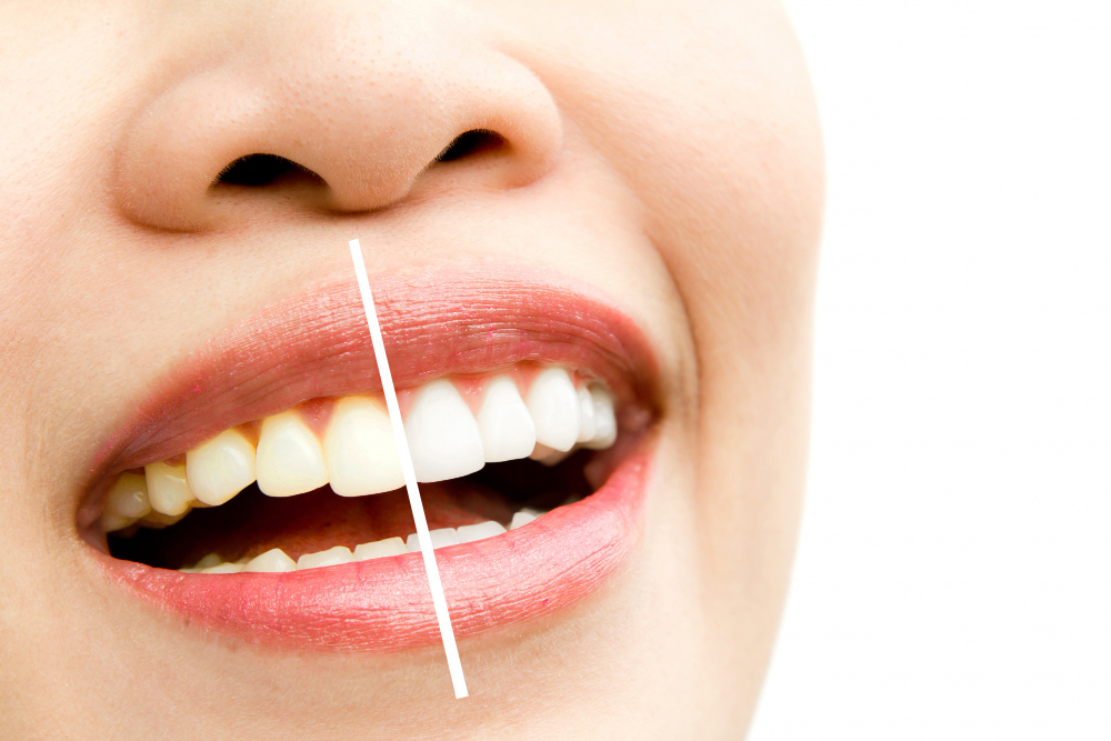 Teeth Whitening: Pros, Cons, ...