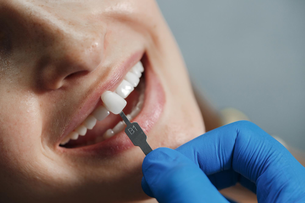 What Is a Dental Crown and Wh...