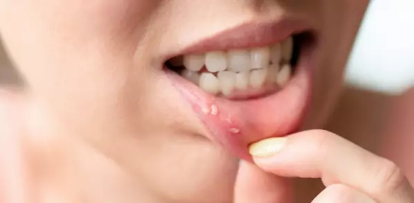 Что такое язвы во рту (афтозные язвы) и как их лечить?
