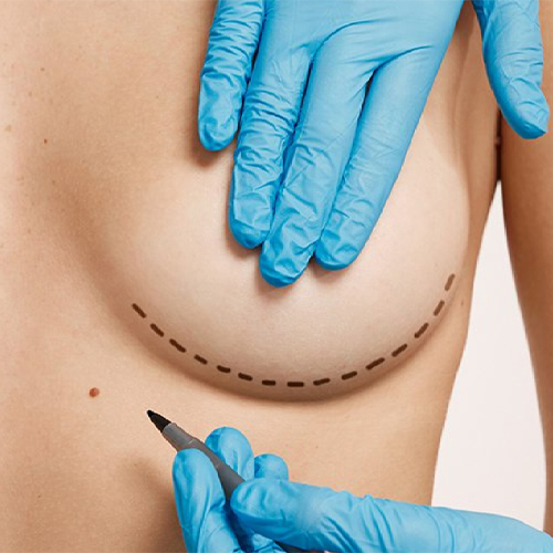 Breast Augmentation 