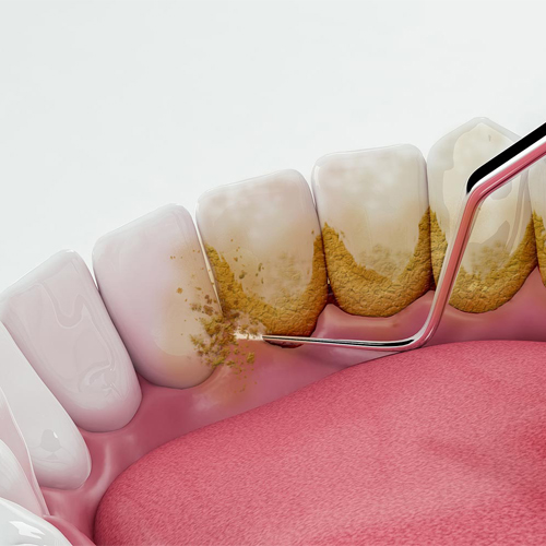 Teeth Cleaning