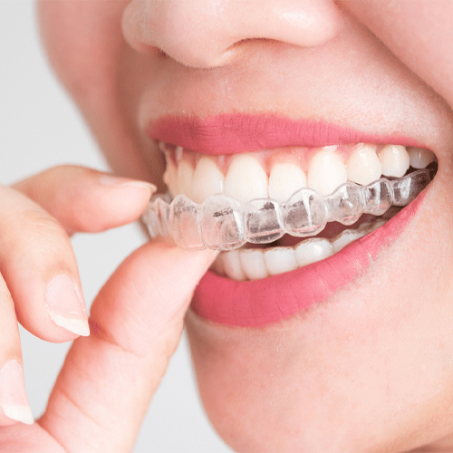 Invisalign Clear Aligners