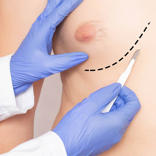 Gynecomastia 